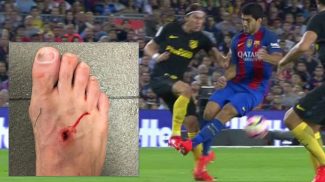 agresion-luis-suarez-3